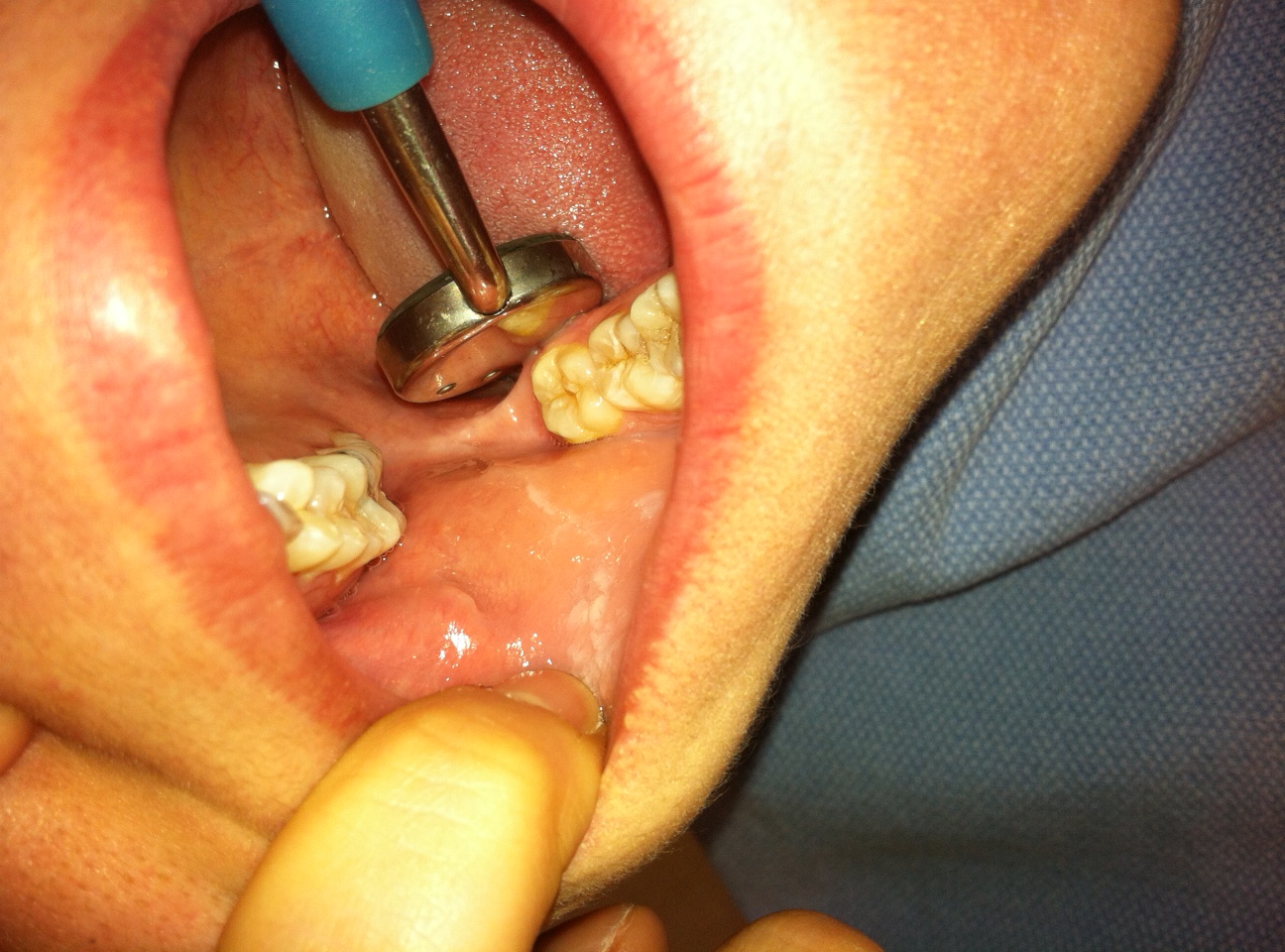 Approximate location for scaling lingual side of upper right and lower right molars and pre-molars