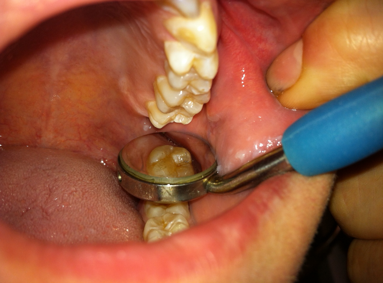 This position gives you a great view of the distal surfaces of upper molars while scaling.