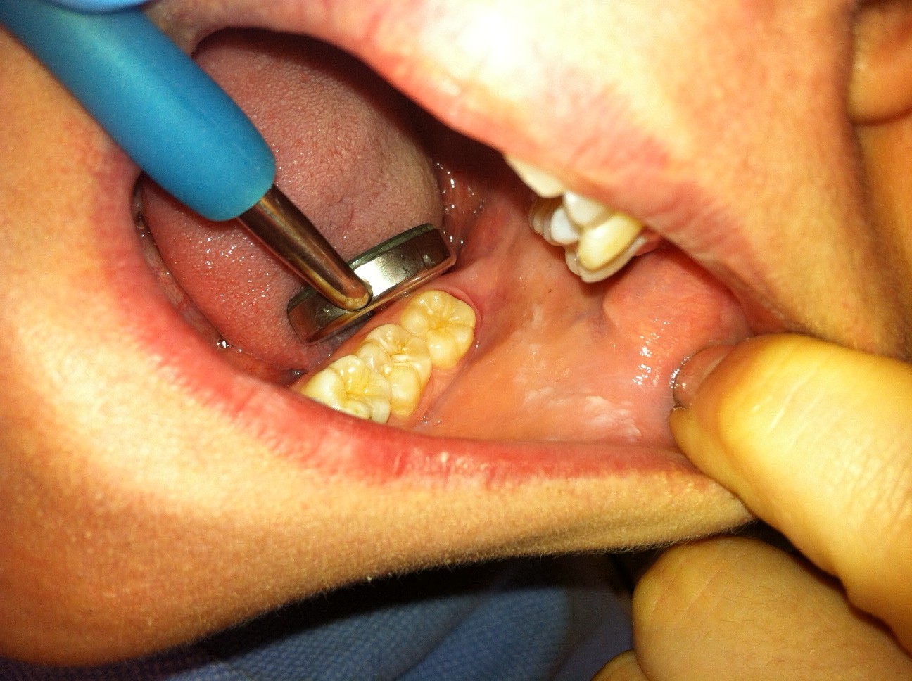 Approximate location to scale the lower left and upper left molars and pre-molars on the lingual side. 